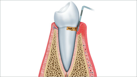 Periodontics Hickory, NC