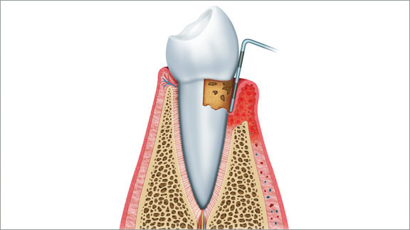 Periodontics Hickory, NC