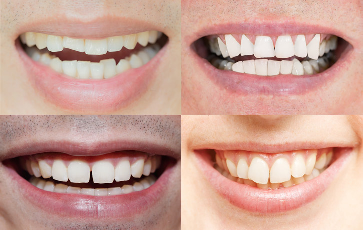 Smile Makeover