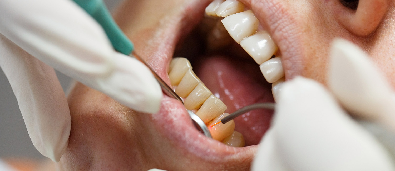 Cosmetic Laser Dentistry Services in Hickory