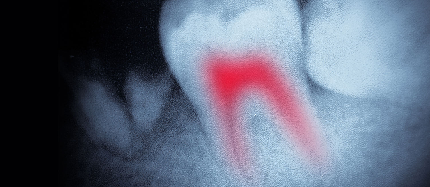 Root Canal Treatment Root Canal Dentist Hickory, NC