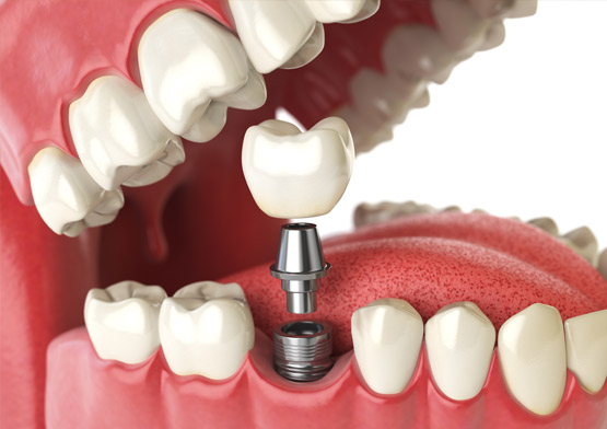 Dental Implant Cost 