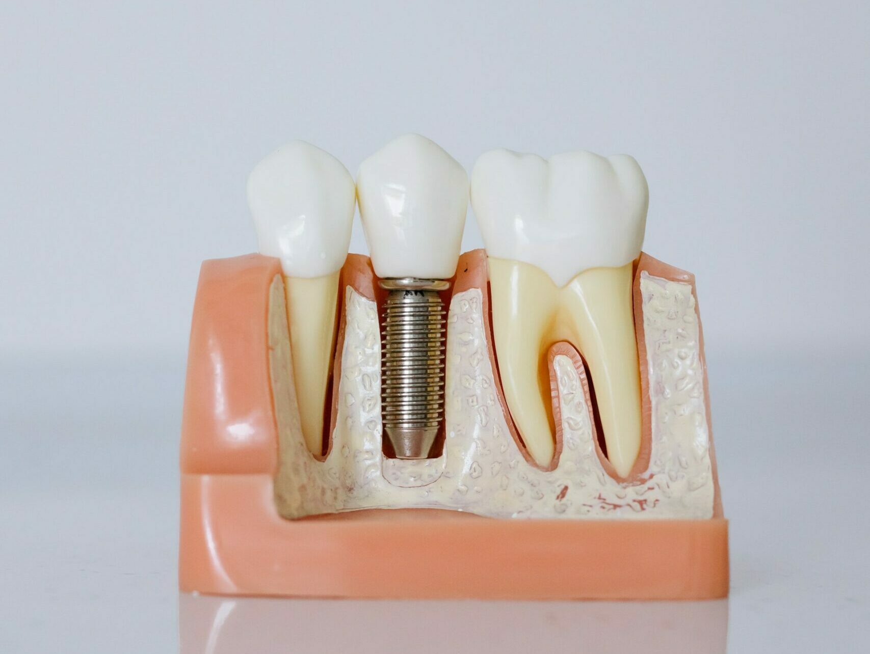 Why Are Dental Implants So Important