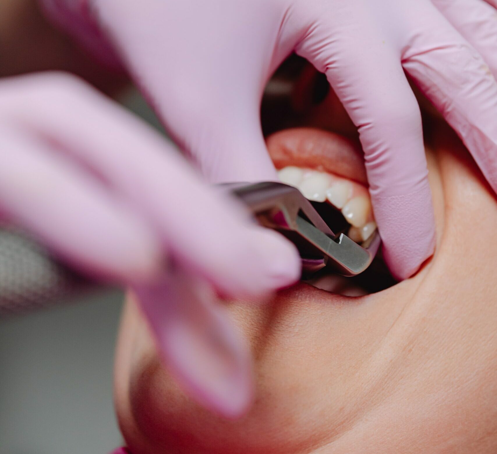 Basics of Emergency Dental Care