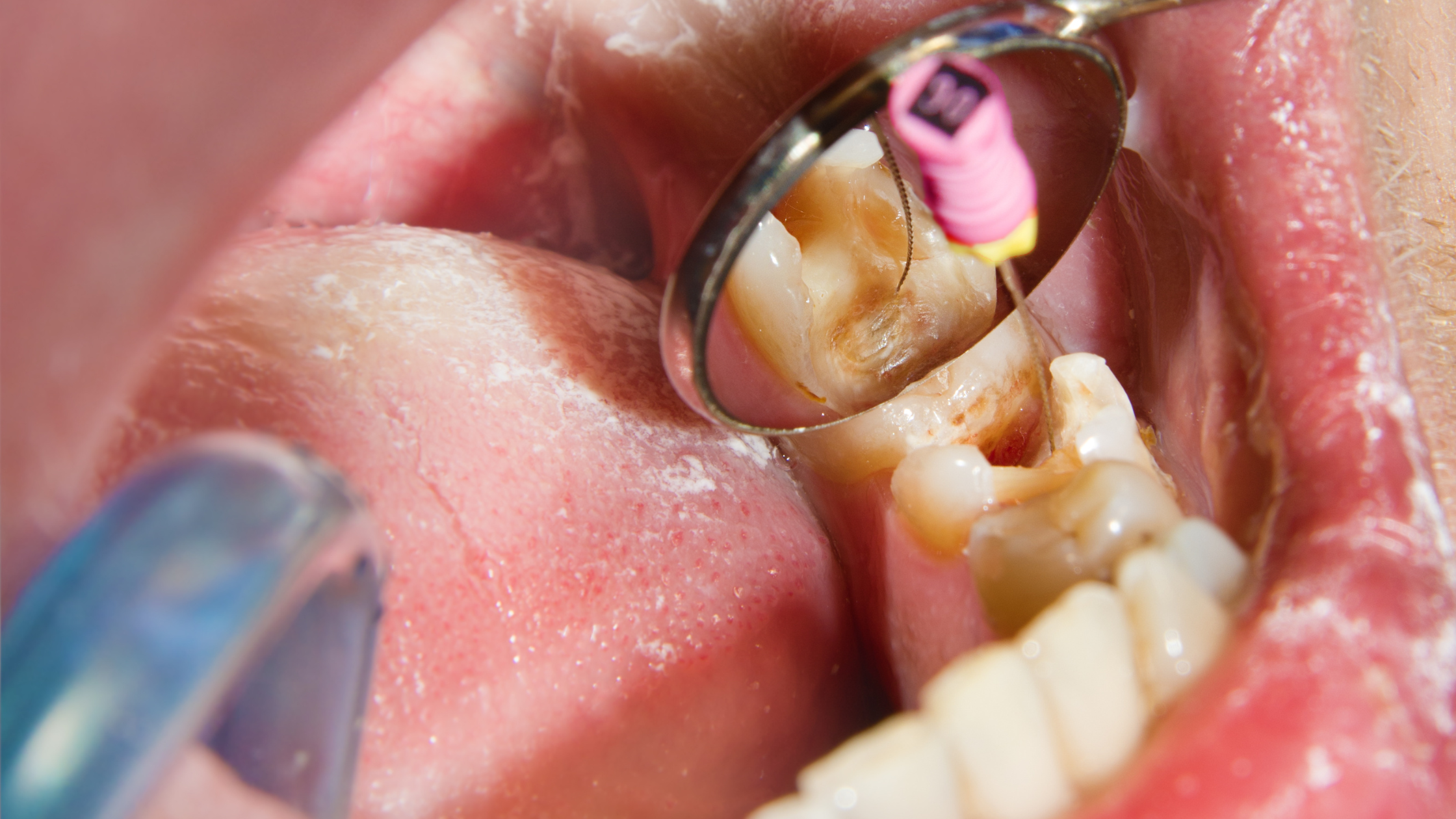 What to Know About Root Canal Treatments