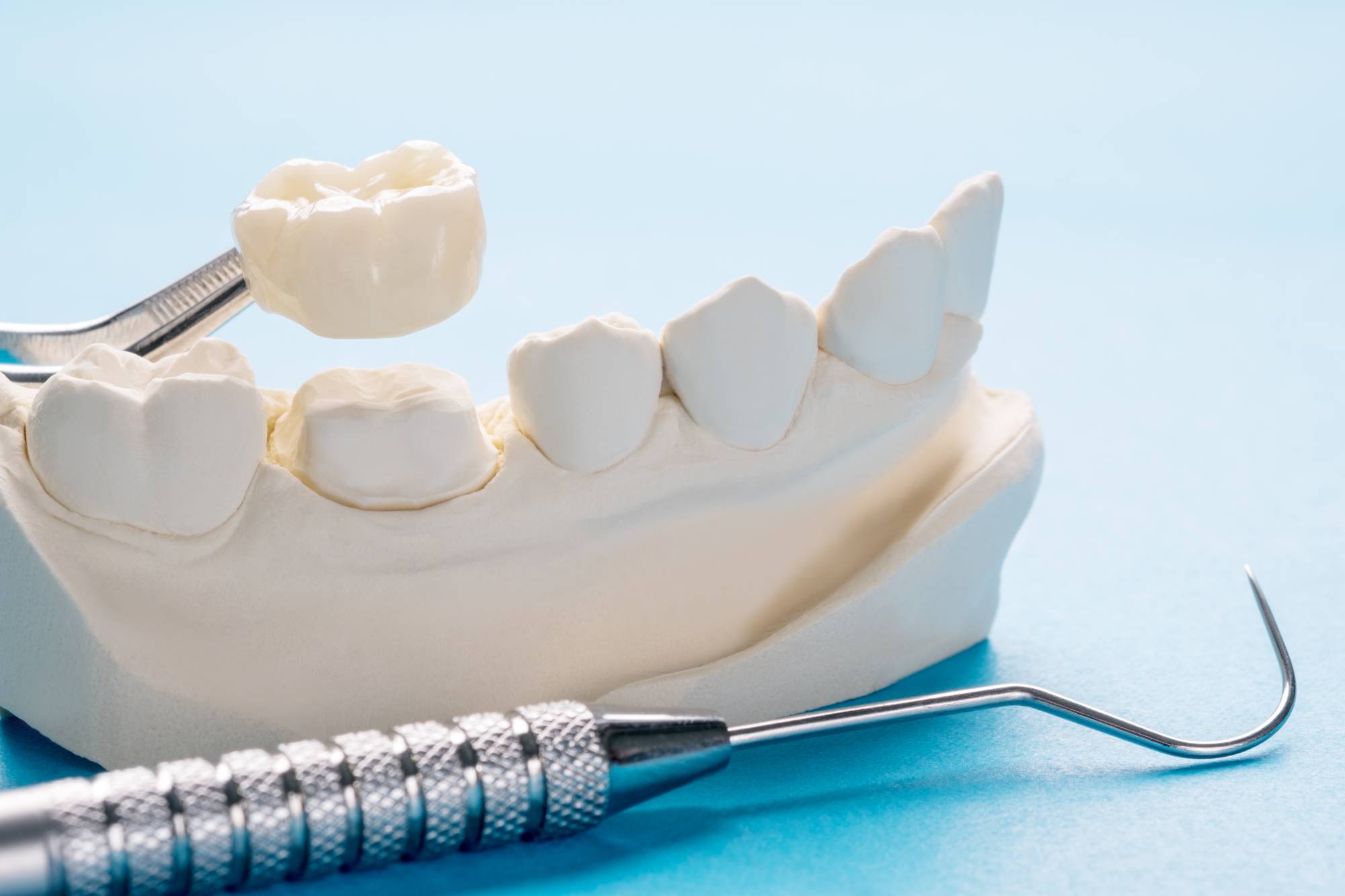 CEREC Dental Crowns