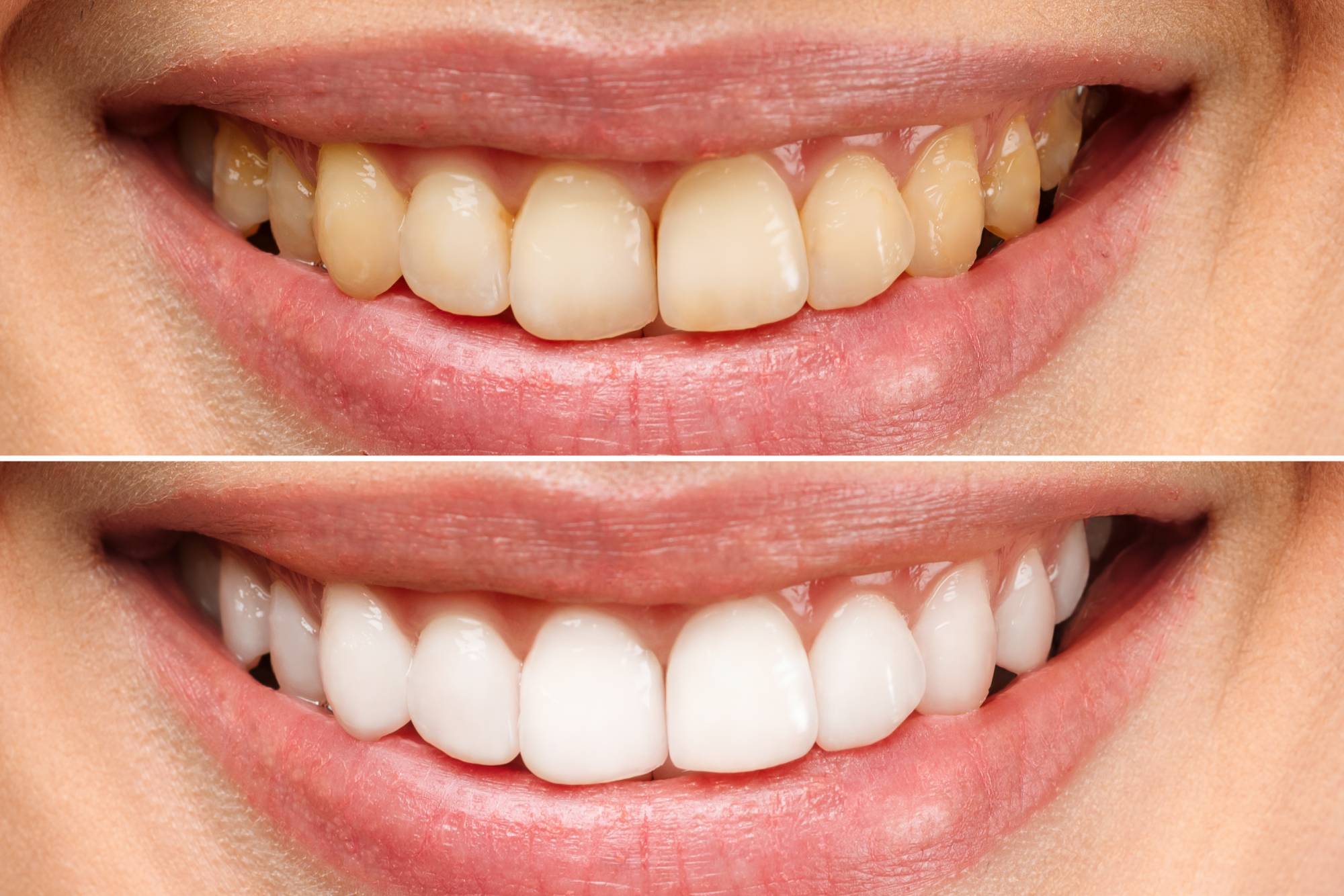 Teeth Whitening
